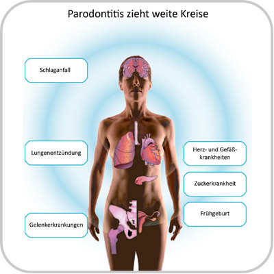 Parodontitis zieht weite Kreise