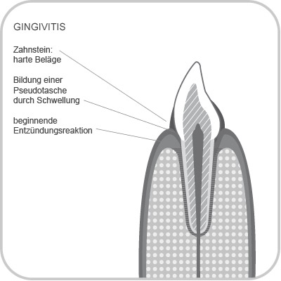 Gengivitis