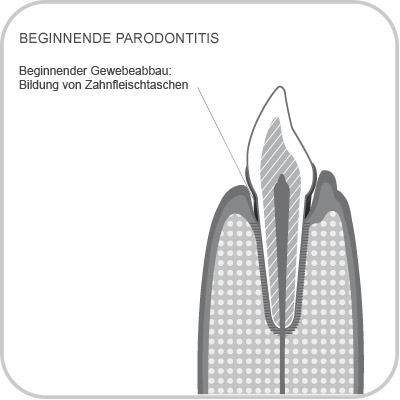 Beginnende Paraodontitis