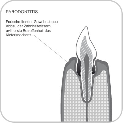 Paraodontitis