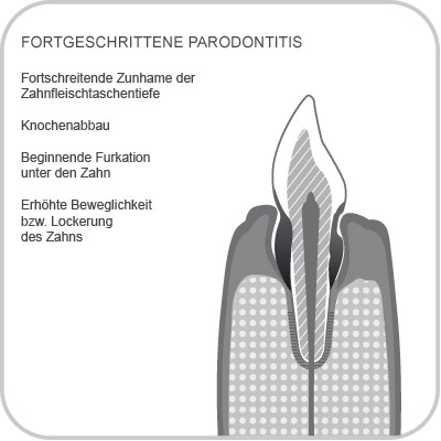 Fortgeschrittene Paraodontitis
