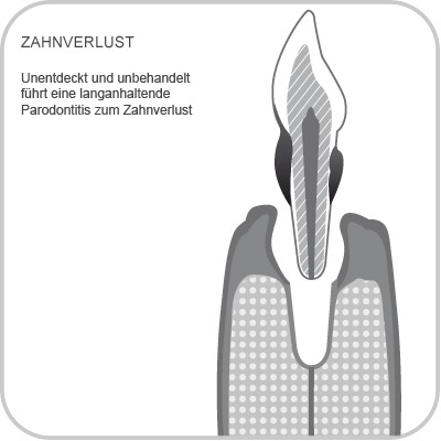 Zahnverlust